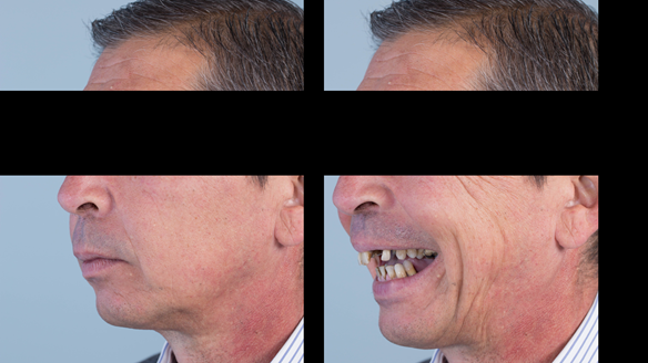 Figure 2 Pre-treatment with generalised periodontitis; stage IV grade C, unstable, risk factors: smoker. Prior to phase one treatment of immediate complete upper denture and immediate mandibular acrylic based partial denture.