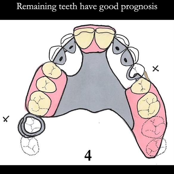 Universal Scandinavian partial denture designs