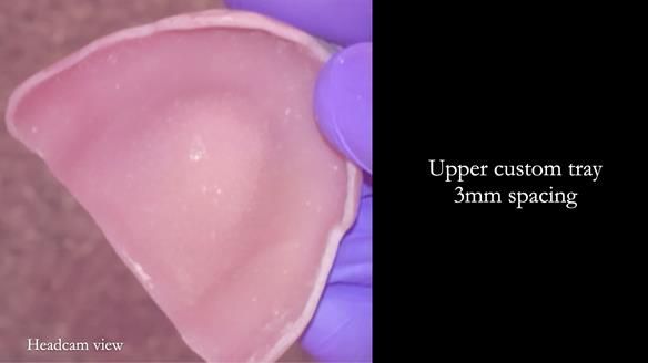 Newsletter 82 Mary - A complete upper and a one-tooth gasket denture