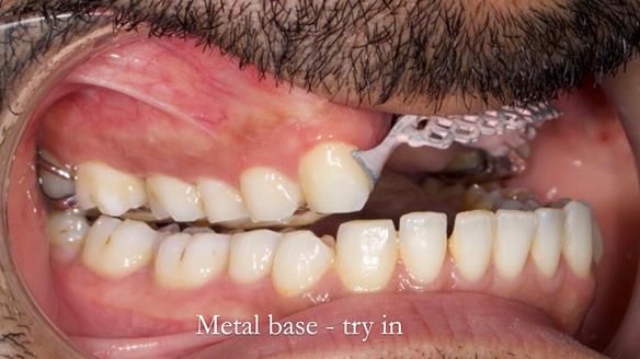 Upper metal base partial denture/occlusal stabilisation splint/obturator - full protocol