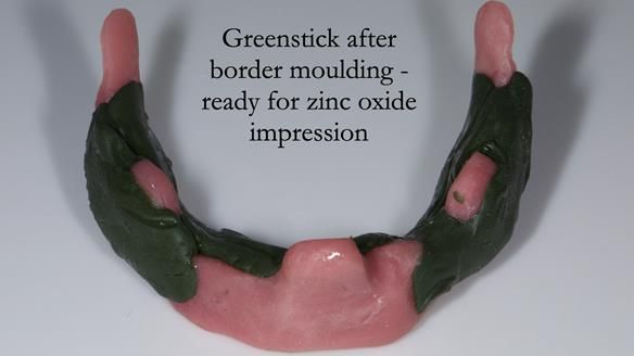 Managing poor implant positioning with complete dentures and Locator attachments - full protocol Newsletter 41