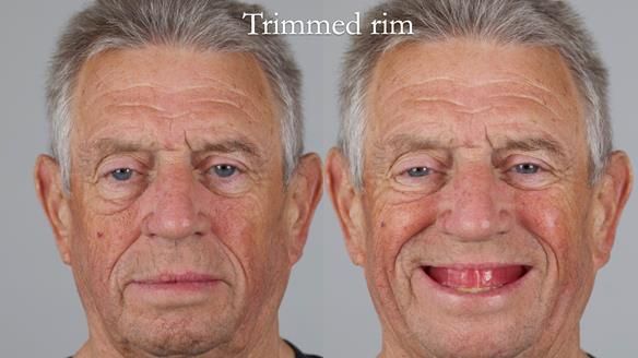 Newsletter 54 case presentation upper complete denture and lower Scandinavian designed hygienic partial denture for David