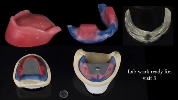 Newsletter 83: Sheila’s Complete Denture Success