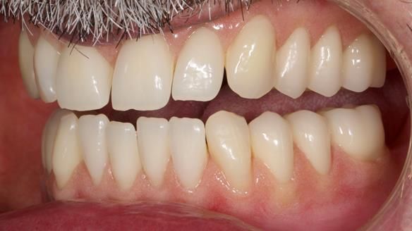 Newsletter 78: What do Clark Gable and a Locator® overdenture have in common?