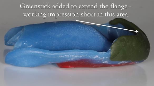 Newsletter 53 showing the making and fitting of ultra life-like dentures for Valena