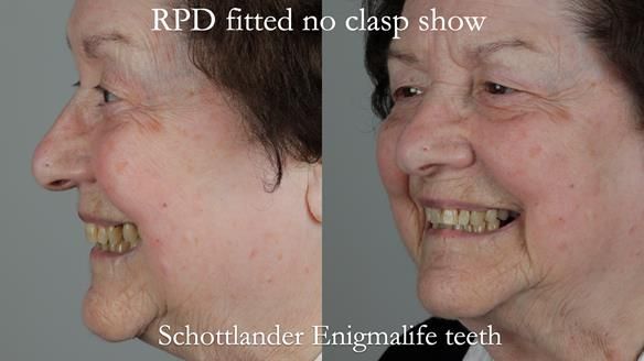 Finlay's Newsletter 60 Sylvia's upper Kennedy Class 2 Mod 1 metal based upper RPD