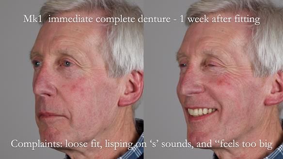 Newsletter 77: Jeremy’s case – immediate complete upper denture