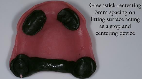 Complete denture Class II div 2 deep overbite Newsletter 39