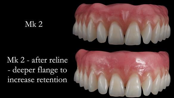 Replacing Madeline’s Complete denture FULL PROTOCOL