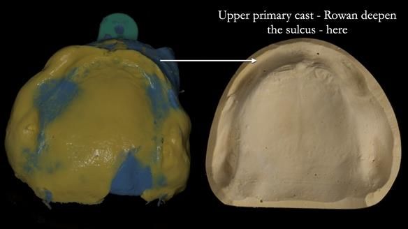 Newsletter 83: Sheila’s Complete Denture Success