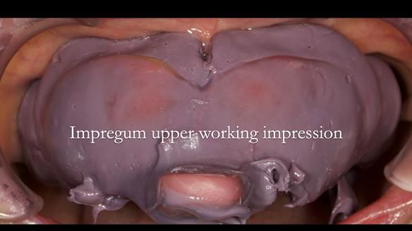 Newsletter 76: Jackie’s case – Telescopic overdenture & precision RPD (the tricky truth!)