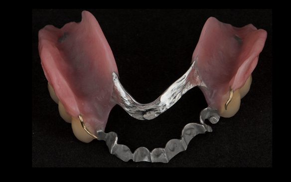 Figure 113 mandibular metal based denture showing fitting surface. Polished bar over the soft tissues. Not polished on tooth support increasing retention