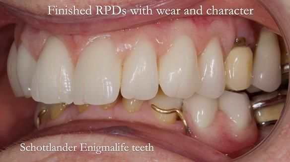 Eileen's transformation with upper and lower RPDs of Scandinavian hygienic design FULL PROTOCOL
