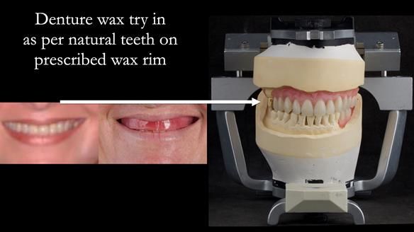 Newsletter 52 Managing Jo’s failing dentition with extractions and Mk 1/Mk 2 complete upper dentures and lower partial dentures FULL PROTOCOL