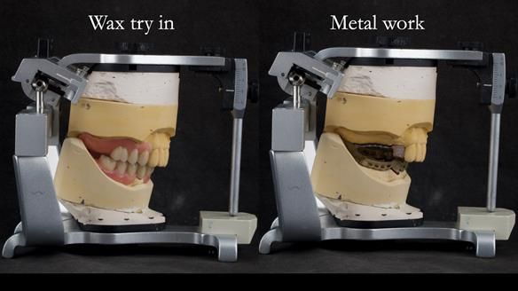 Newsletter 76: Jackie’s case – Telescopic overdenture & precision RPD (the tricky truth!)
