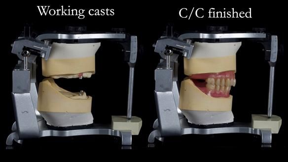 Newsletter 57 showcases the making and fitting process of implant-supported complete dentures for Alisdair