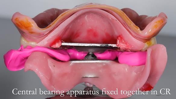 Newsletter 54 case presentation upper complete denture and lower Scandinavian designed hygienic partial denture for David