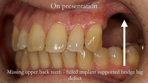 Solving Sue's failed implants with metal based RPD - full protocol Newsletter 43