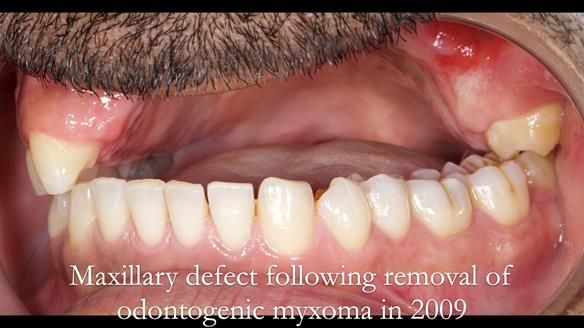 Upper metal base partial denture/occlusal stabilisation splint/obturator - full protocol