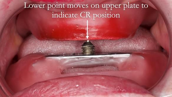 Replacing Madeline’s Complete denture FULL PROTOCOL