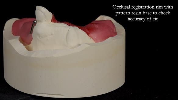 Newsletter 55 Provision of metal based partial dentures for Zephyrine with a repaired cleft lip and palate