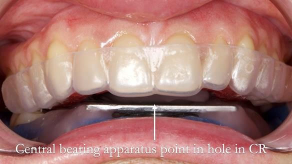 Newsletter 82 Mary - A complete upper and a one-tooth gasket denture