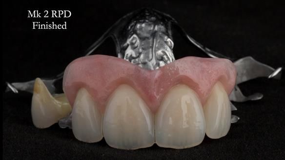 Finlay's Newsletter 63 Case study provision of metal based Scandinavian RPD - functional 10 years on