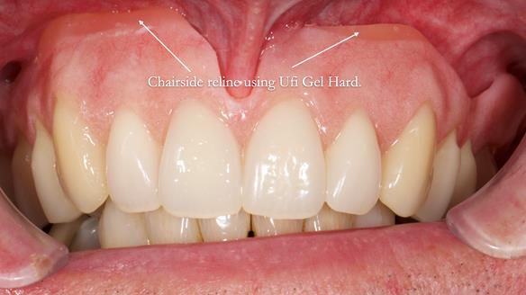 Newsletter 77: Jeremy’s case – immediate complete upper denture