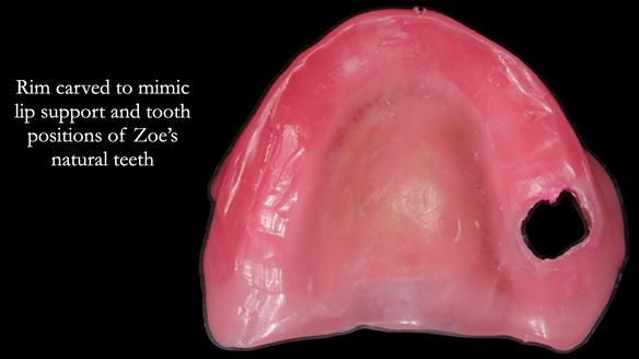 Finlay's Newsletter 58 Gasket upper partial denture for Zoe