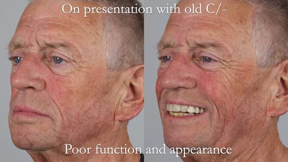 Newsletter 54 case presentation upper complete denture and lower Scandinavian designed hygienic partial denture for David