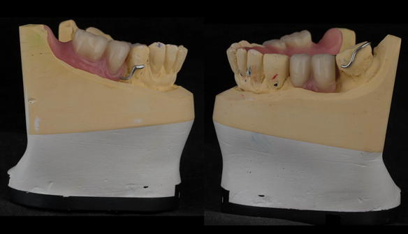 Figure 26 Finished upper immediate denture - 0.9mm stainless steel wire. UR gingivally approaching UL occlusally approaching
