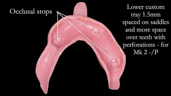Newsletter 54 case presentation upper complete denture and lower Scandinavian designed hygienic partial denture for David