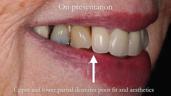 Finlay's Newsletter 59 Ultra hard partial dentures made for Gill