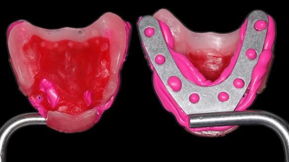Finlay's Newsletter 59 Ultra hard partial dentures made for Gill