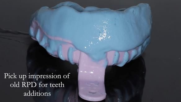 Finlay's Newsletter 62 provision of extractions and metal based complete dentures for Rafique