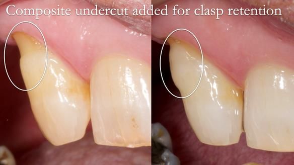 Newsletter 86 Peter the Architect — precision removable partial dentures case study