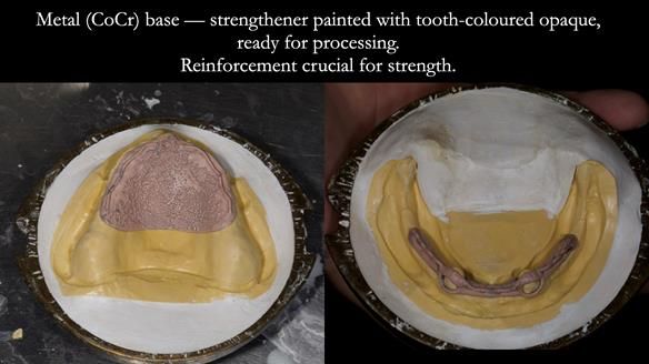 Newsletter 78: What do Clark Gable and a Locator® overdenture have in common?