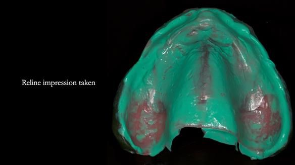 Newsletter 77: Jeremy’s case – immediate complete upper denture