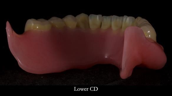 Newsletter 83: Sheila’s Complete Denture Success