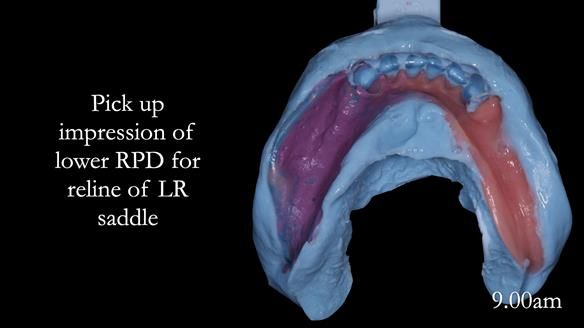 Newsletter 52 Managing Jo’s failing dentition with extractions and Mk 1/Mk 2 complete upper dentures and lower partial dentures FULL PROTOCOL