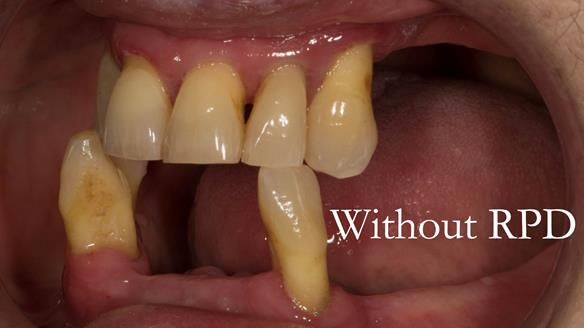 Finlay's Case Study Newsletter 40 - Immediate Mk 1 RPD to Definitive Mk 2 RPD - full protocol