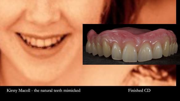 Newsletter 83: Sheila’s Complete Denture Success