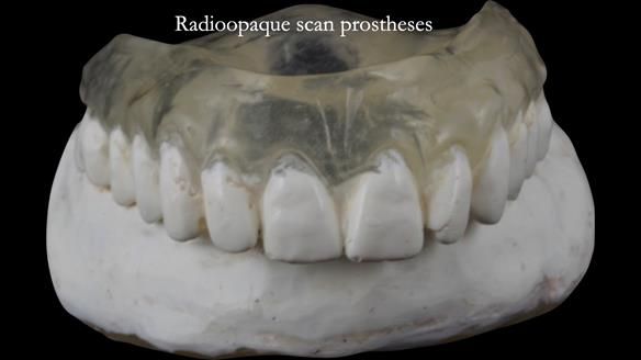 Replacing Madeline’s Complete denture FULL PROTOCOL