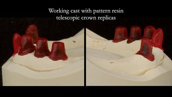 Newsletter 76: Jackie’s case – Telescopic overdenture & precision RPD (the tricky truth!)