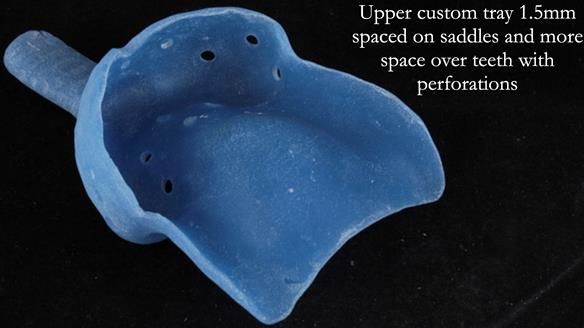 Newsletter 56 showing the making and fitting of a bilateral free end saddle upper removable partial denture (RPD) for patient with pemphigus