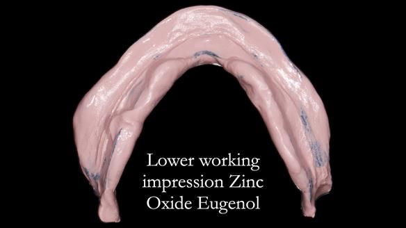 Newsletter 80 - Gordon’s dentures: the one case in 1,000 where my technique failed
