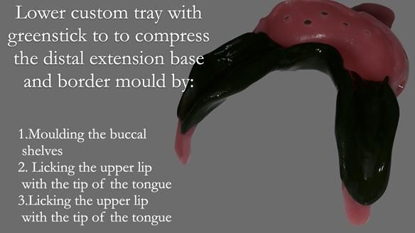 Newsletter 52 Managing Jo’s failing dentition with extractions and Mk 1/Mk 2 complete upper dentures and lower partial dentures FULL PROTOCOL
