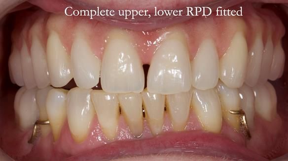 Solving Linda’s Failed “All on 4” implant bridges - full protocol Newsletter 42