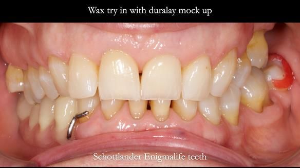 Finlay's Newsletter 61 provision of a lower unilateral free end saddle metal based partial denture for Joyce