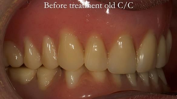 Complete denture Class II div 2 deep overbite Newsletter 39